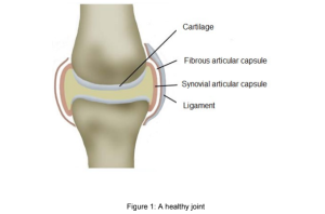 f1 - Knee and Hip Arthritis - Platinum Physio